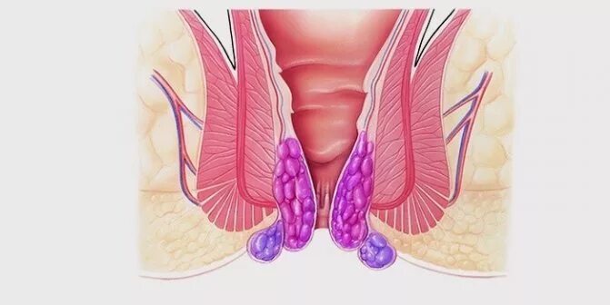 Покажи картинки как выглядит геморрой ⛑ Геморрой 2 степени: стадии лечения и профилактика