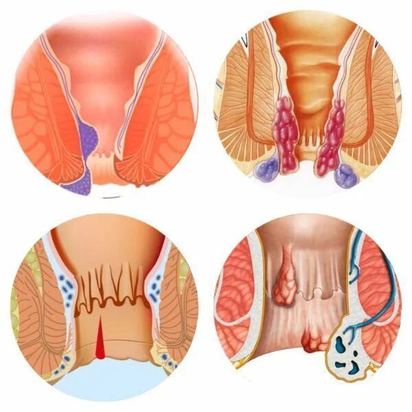 Покажи картинки как выглядит геморрой Pin on Health