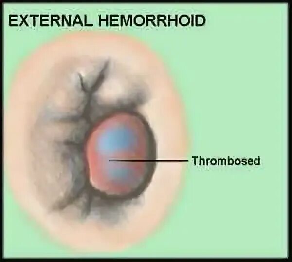 Покажи картинки как выглядит геморрой Вокруг отверстия