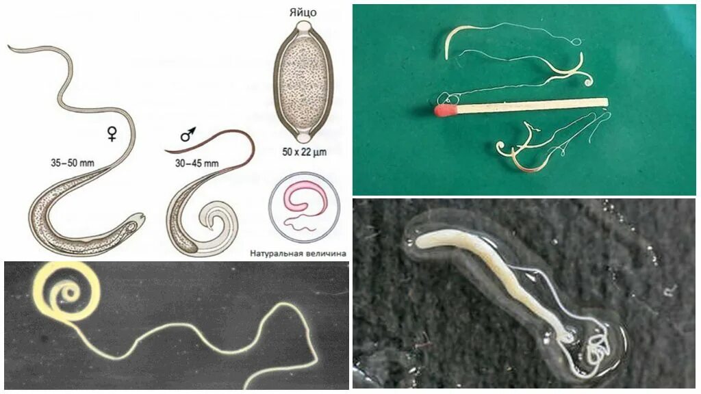 Покажи картинку как выглядят глисты Виды глистов у человека - фото и описание