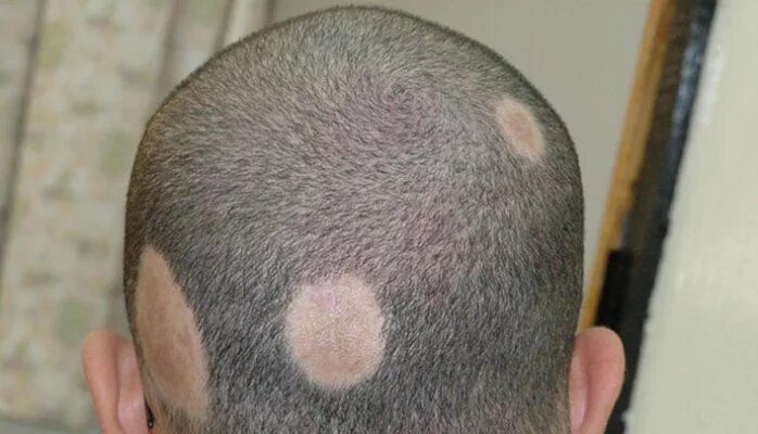 Покажите фото стригущего лишая Pin on Androgenetic Alopecia