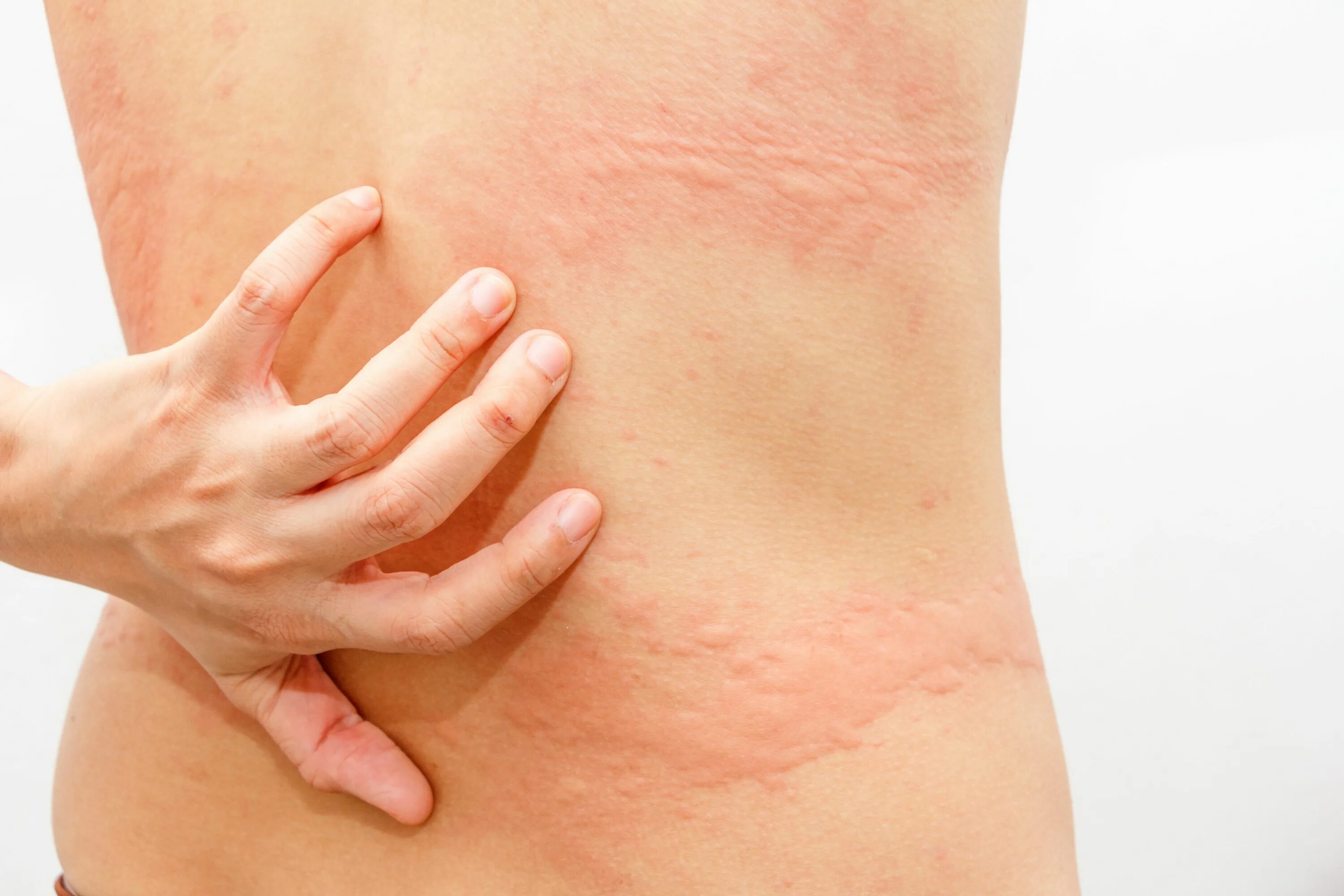 Покажите как выглядит аллергия Dupilumab Significantly Decreased Itch and Hives in Patients with Chronic Sponta