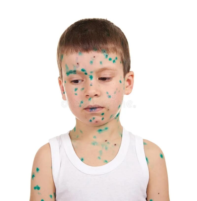 Покажите как выглядит ветрянка Sick Child Has the Virus on Skin Stock Photo - Image of smallpox, patient: 68447