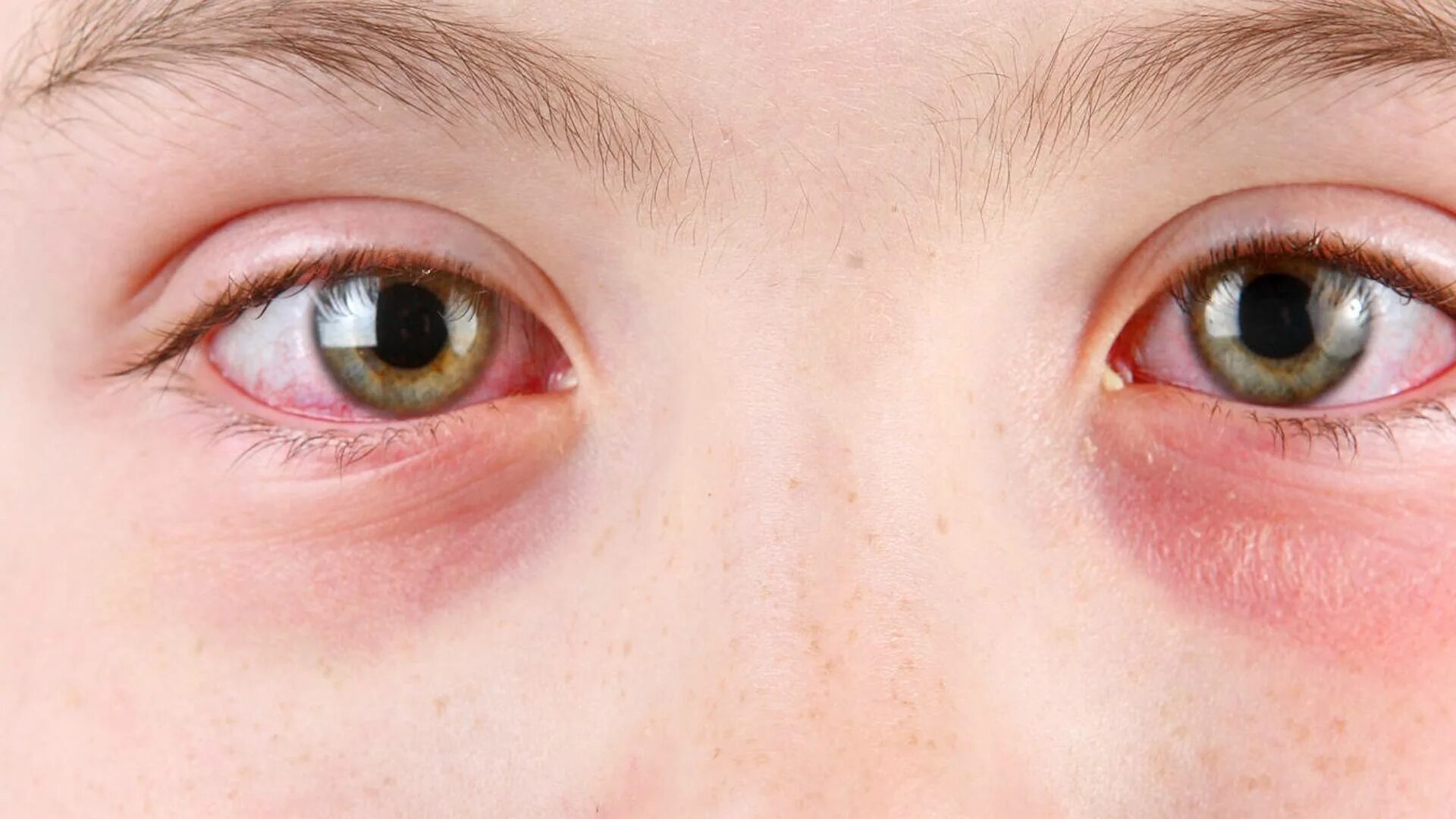 Покраснели глаза фото Mayo Clinic Minute: What is pink eye? - Mayo Clinic News Network