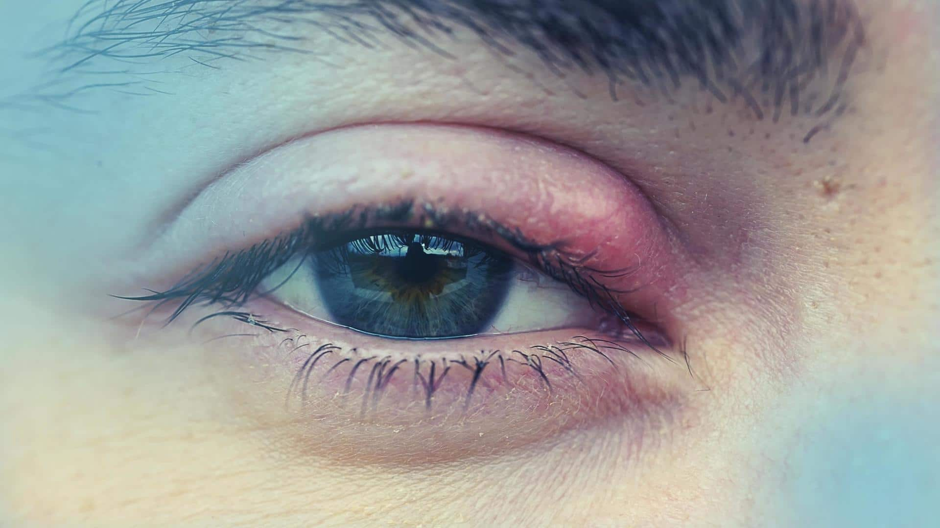 Покраснели глаза фото Stye (sty): Meaning, causes, symptoms, treatment, and prevention