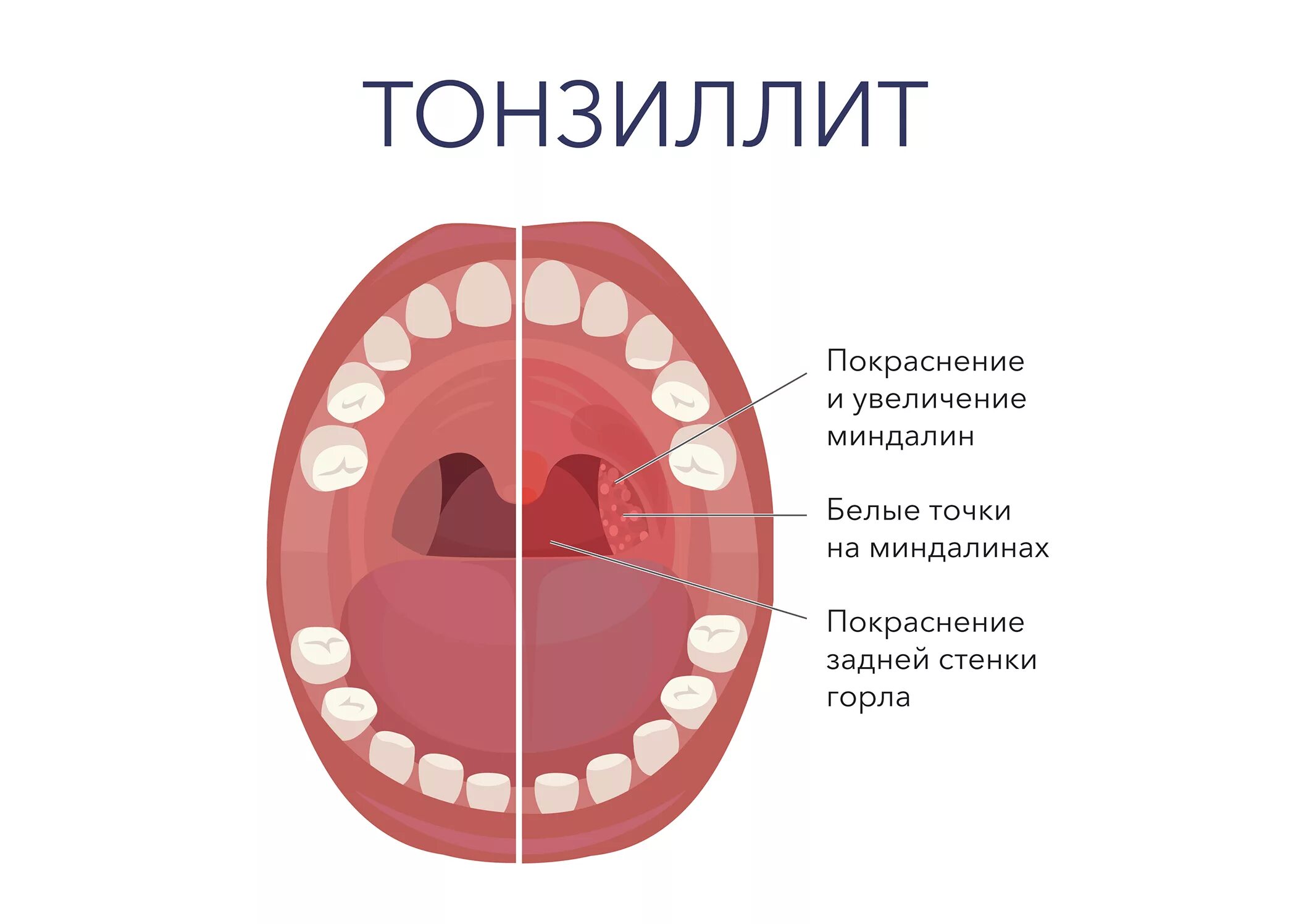 Покраснение горла фото ЛОДЭ медицинский центр - новости компании