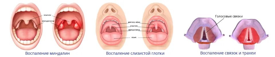 Покраснение горла у ребенка фото Разбираем причины покраснения и першения в горле - Фарингоспрей