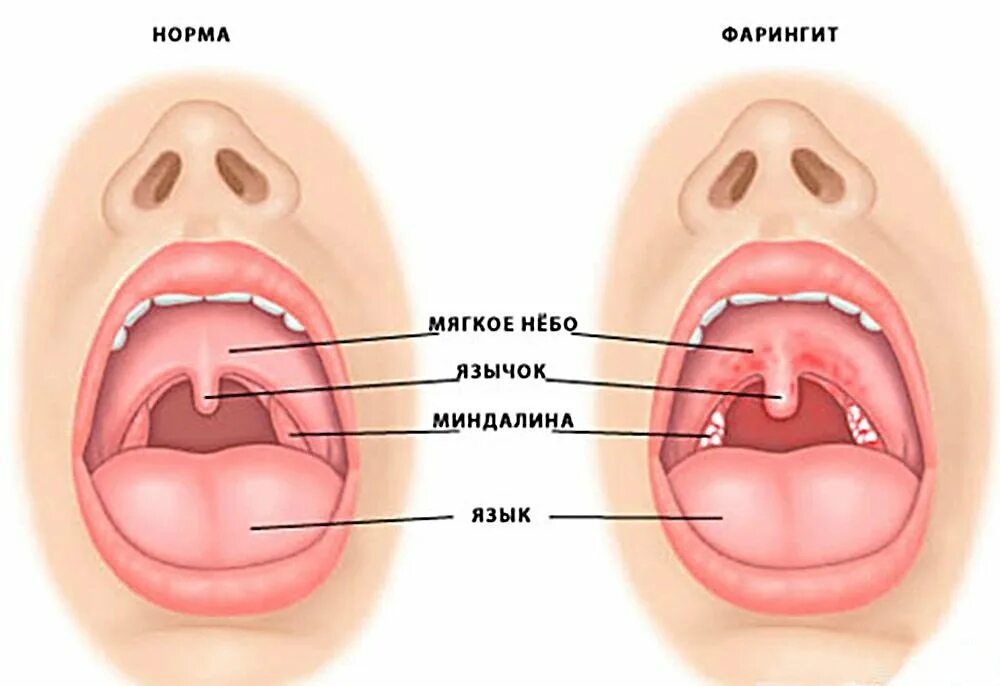 Покраснение горла у ребенка фото Сколько болит горло при фарингите, сколько длится сама болезнь