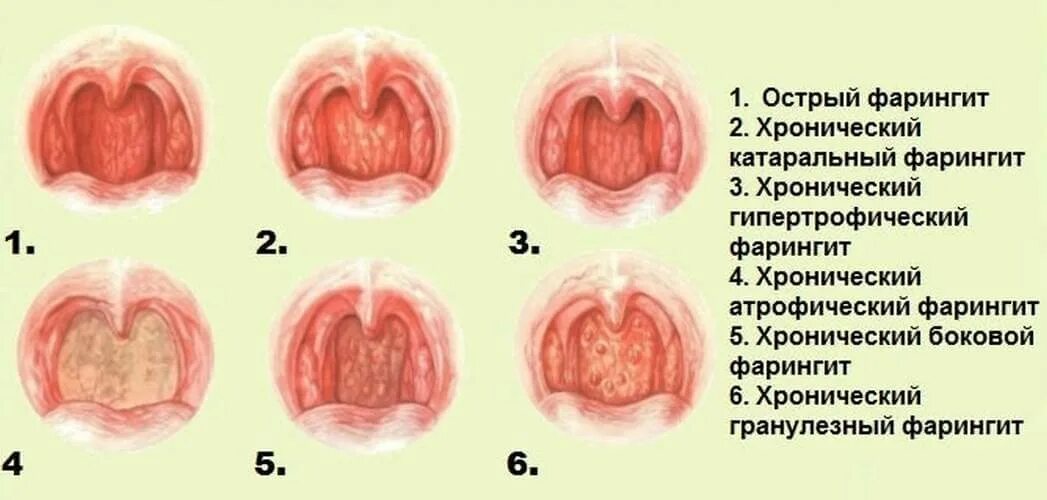 Покраснение горла у ребенка фото Тест глотки