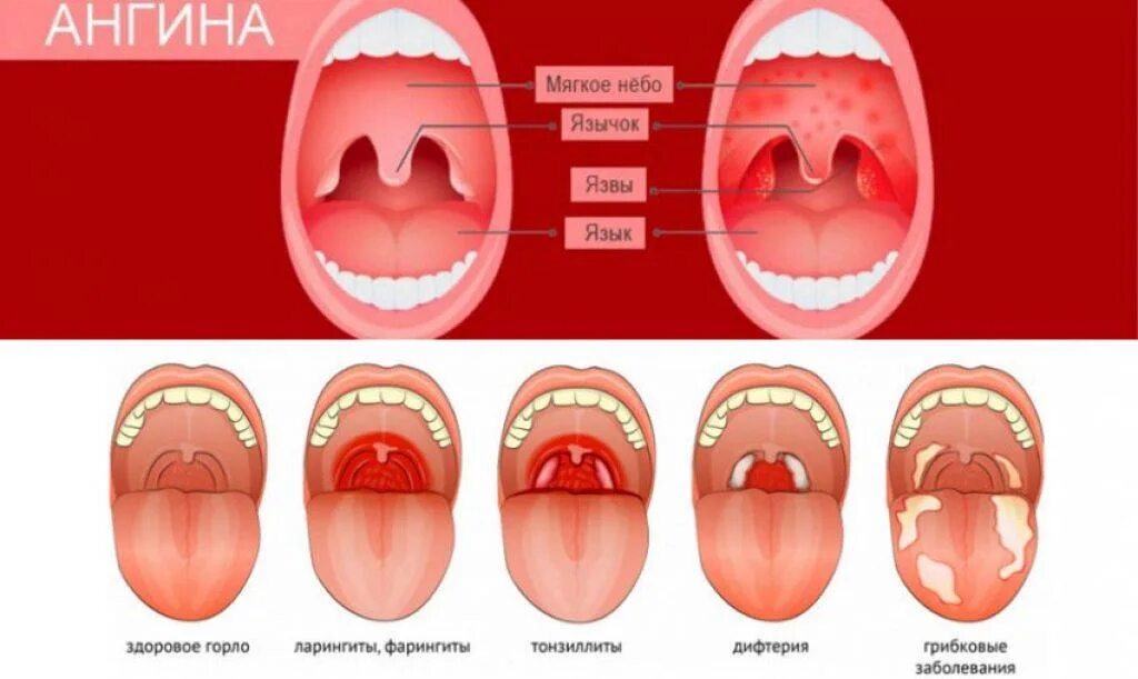 Покраснение горла у ребенка фото Герпетическая ангина у беременных - почему возникает и что с этим делать? О детс