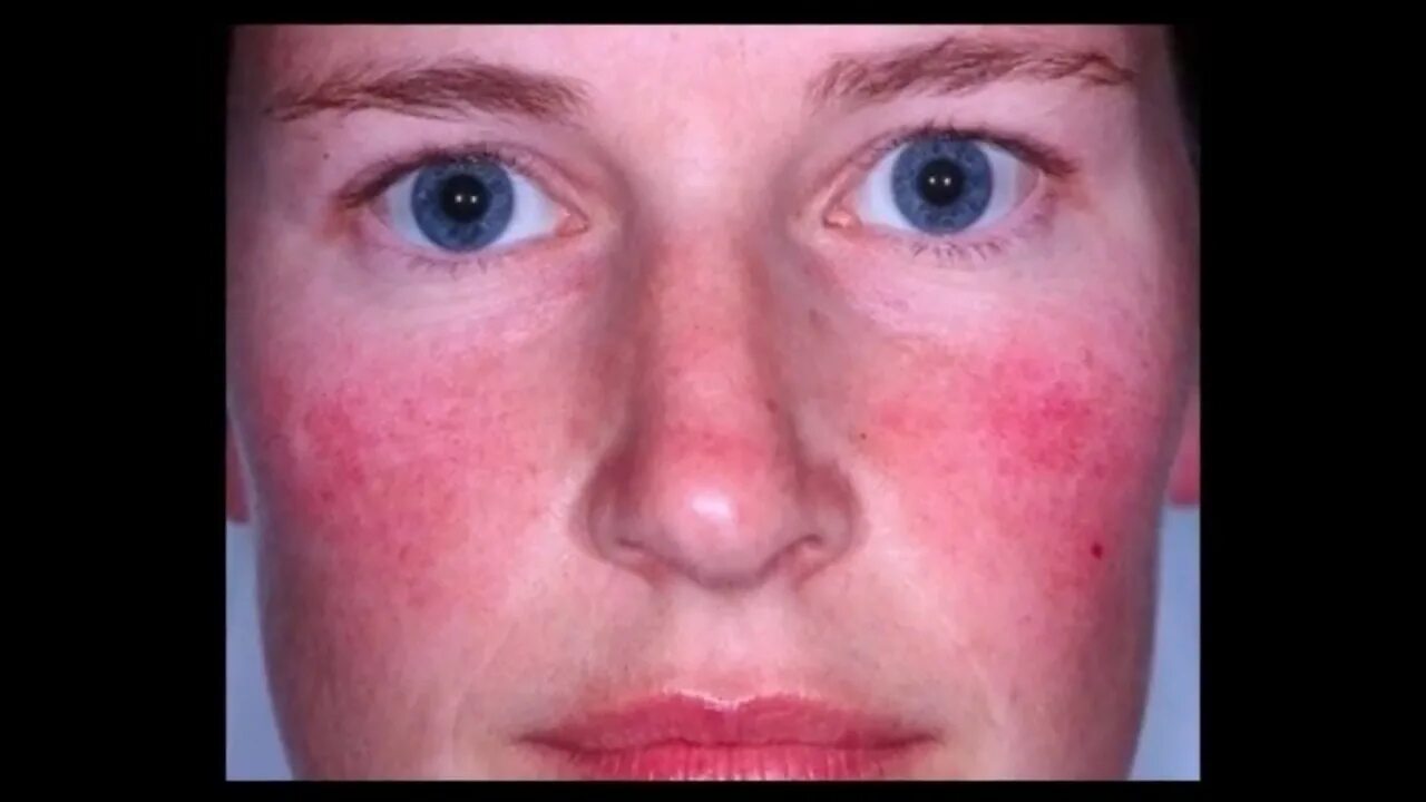 Покраснение на лице в виде бабочки фото Rosacea - Rosacea Remedios Caseros - Funciona? - En La Cara y En La Piel - Guia 