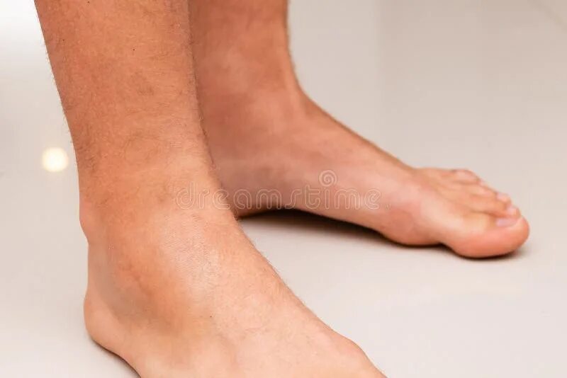 Покраснение на ноге выше щиколотки фото Swollen Leg after Ankle Sprain Stock Image - Image of caucasian, broken: 1700786