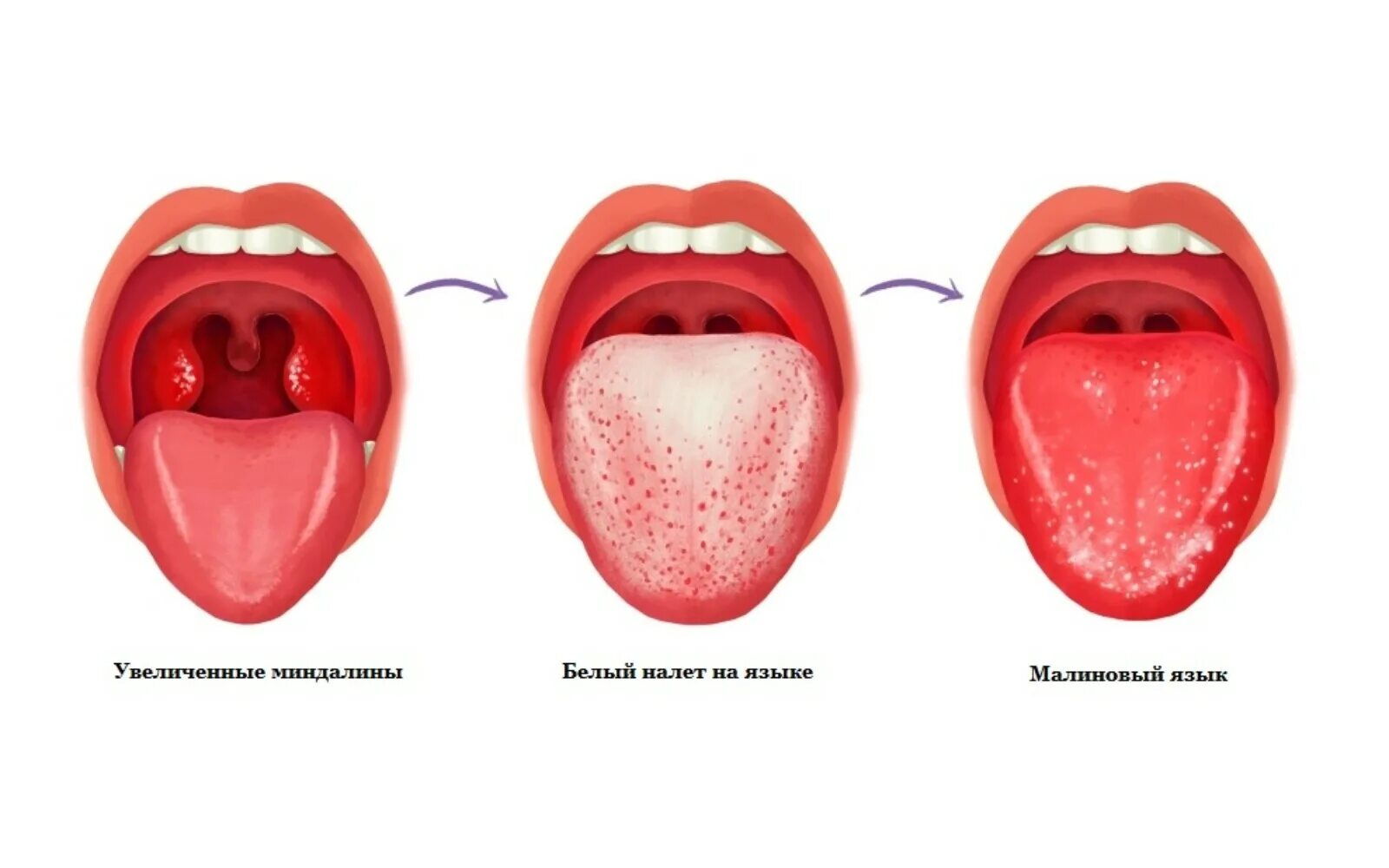 Покраснение неба фото Скарлатина: симптомы, диагностика и лечение ЛДЦ Здоровье