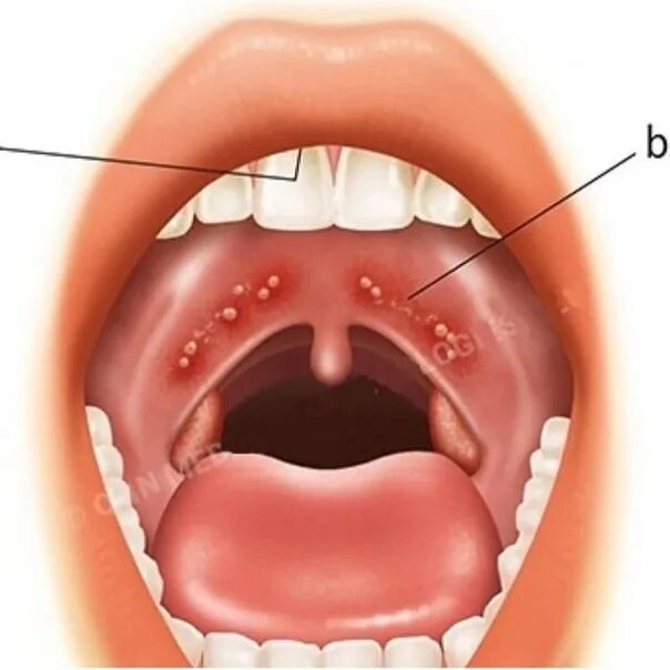 Покраснение неба фото HERPANGINA ❗ The name of this disease is misleading not only parents, but also s