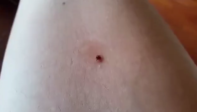 Покраснение после укуса клеща фото Watch this woman get a gross tick out of her arm. but DON’T try this at home The