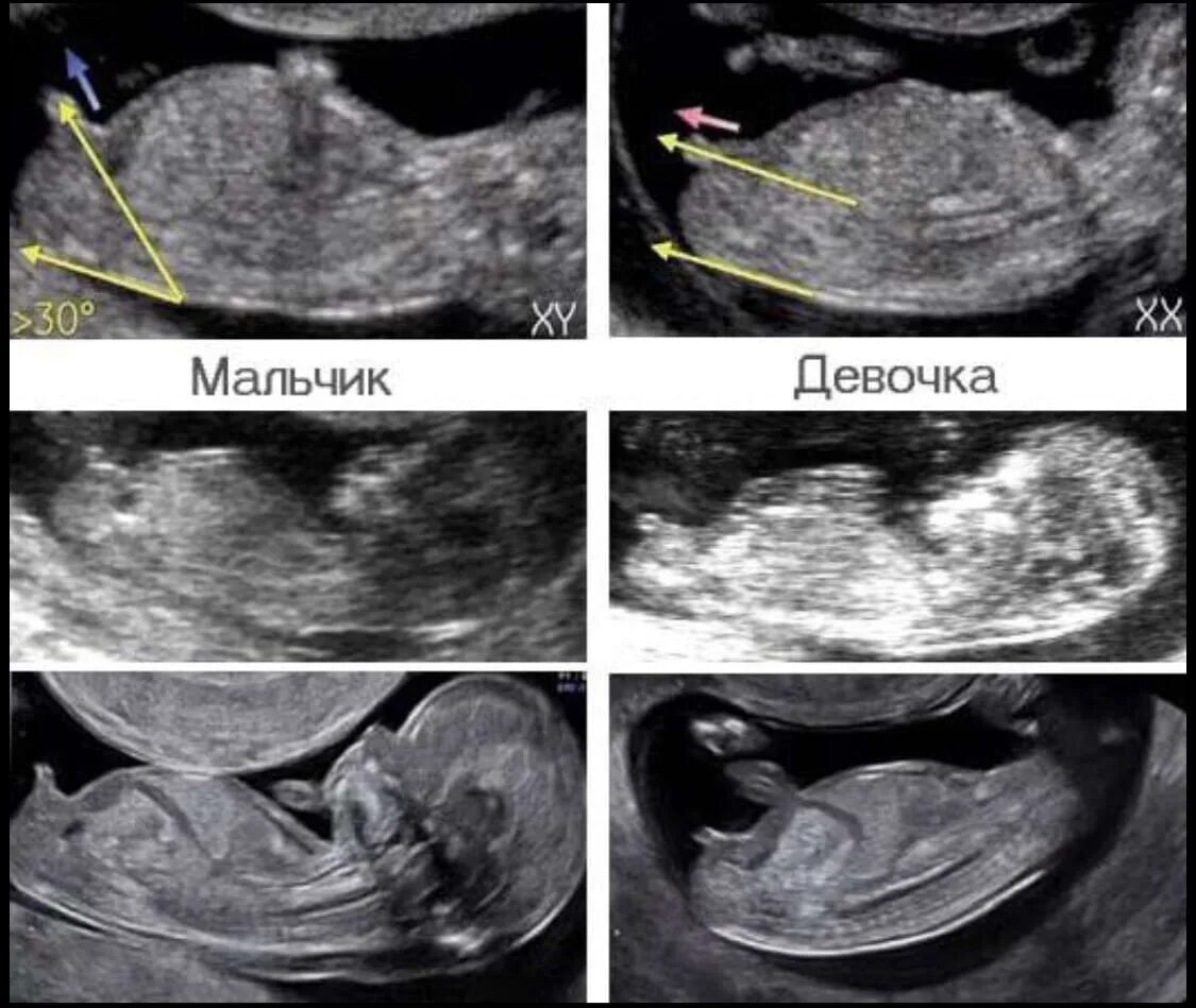 Пол ребенка 12 недель фото Узи пола