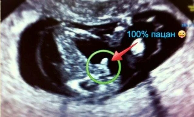 Пол ребенка 12 недель фото 12 недель беременности пол ребенка