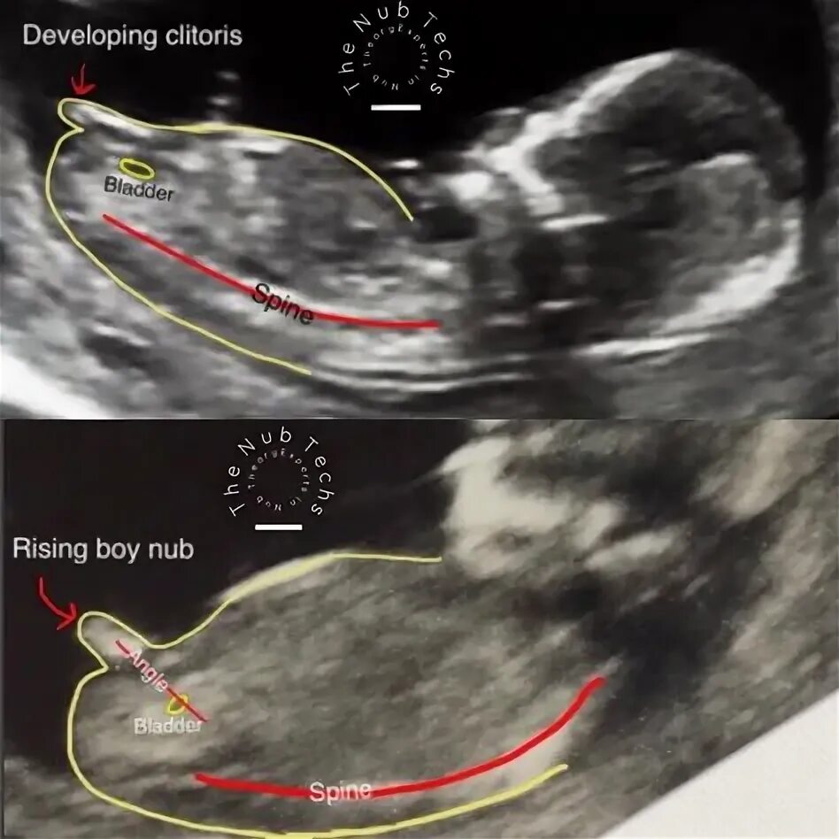 Пол ребенка 12 недель фото 11 Ultrasound gender ideas in 2021 ultrasound gender, ultrasound, gender predict