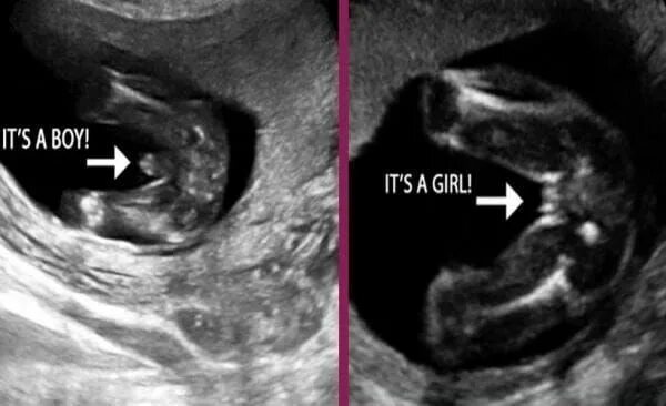 Пол ребенка 12 недель фото I'm pregnet Baby gender ultrasound, Gender reveal ultrasound, Ultrasound gender