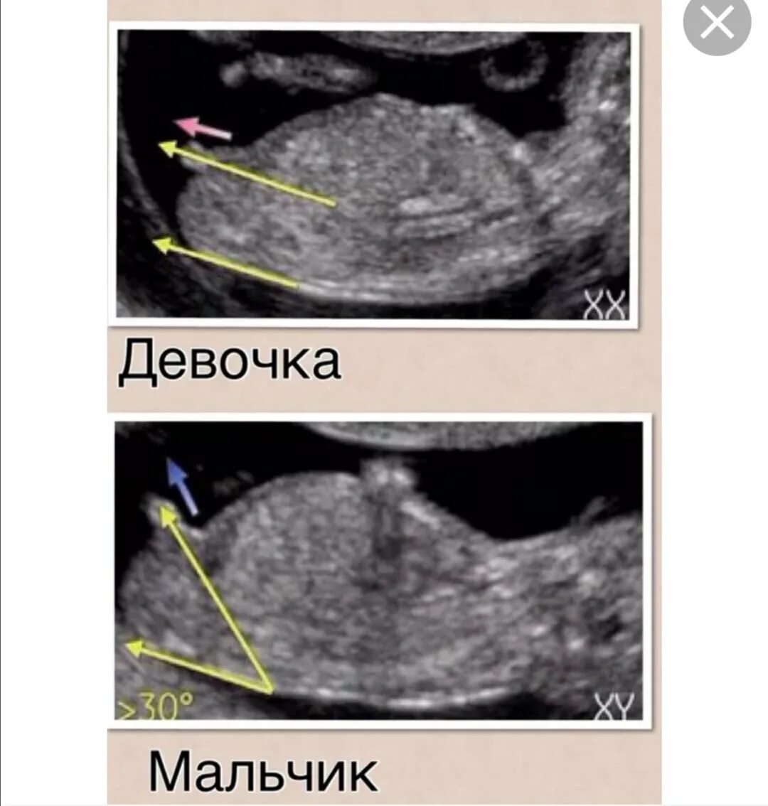 Пол ребенка 12 недель фото Узи пола