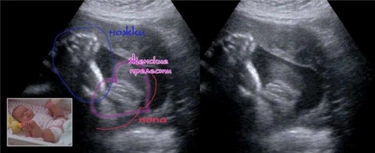 Пол ребенка 20 недель фото Отличия мальчика и девочки на фото по результатам проведенного УЗИ, общие черты 