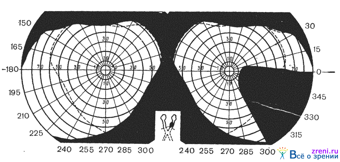 Поле зрения фото Изменения органа зрения при заболеваниях центральной нервной системы Часть 2.