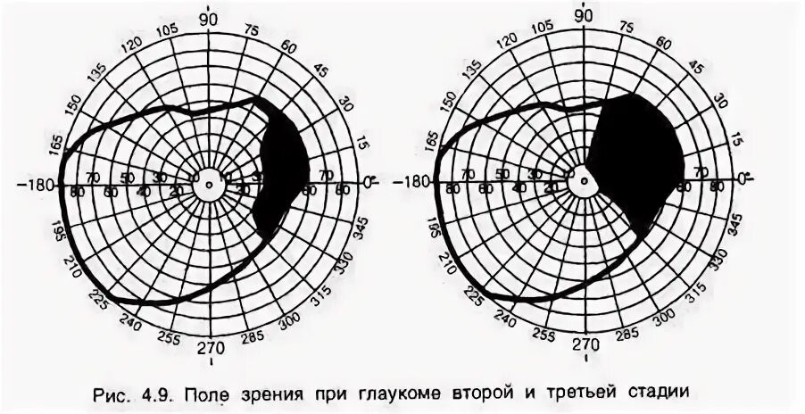 Поле зрения фото О чем свидетельствует нарушение полей зрения?