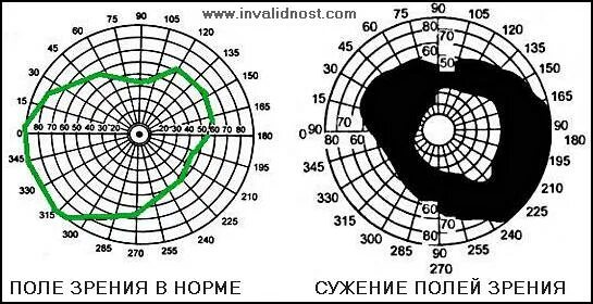 Поле зрения фото инвалидность при сахарном диабете - Страница 7 - Форум
