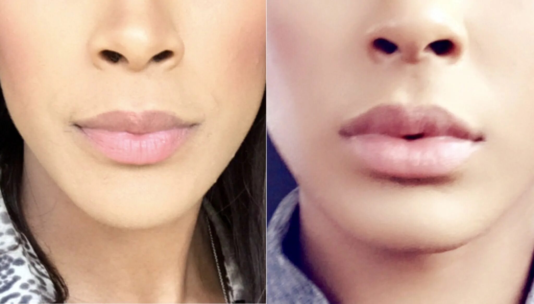 Поли робсона губы как фото 1 syringe of lip fillers #juvederm# lipfillers# beauty# kardashian# kyliejenner 