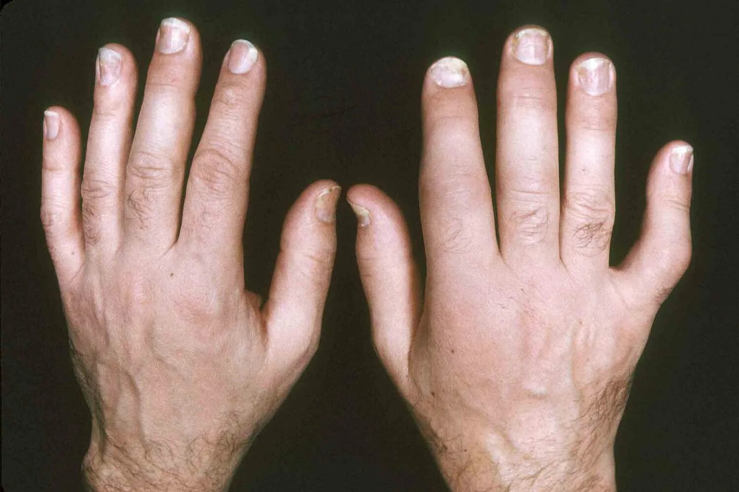 Полиартрит кистей рук симптомы лечение и фото Psoriatic Arthritis Pictures