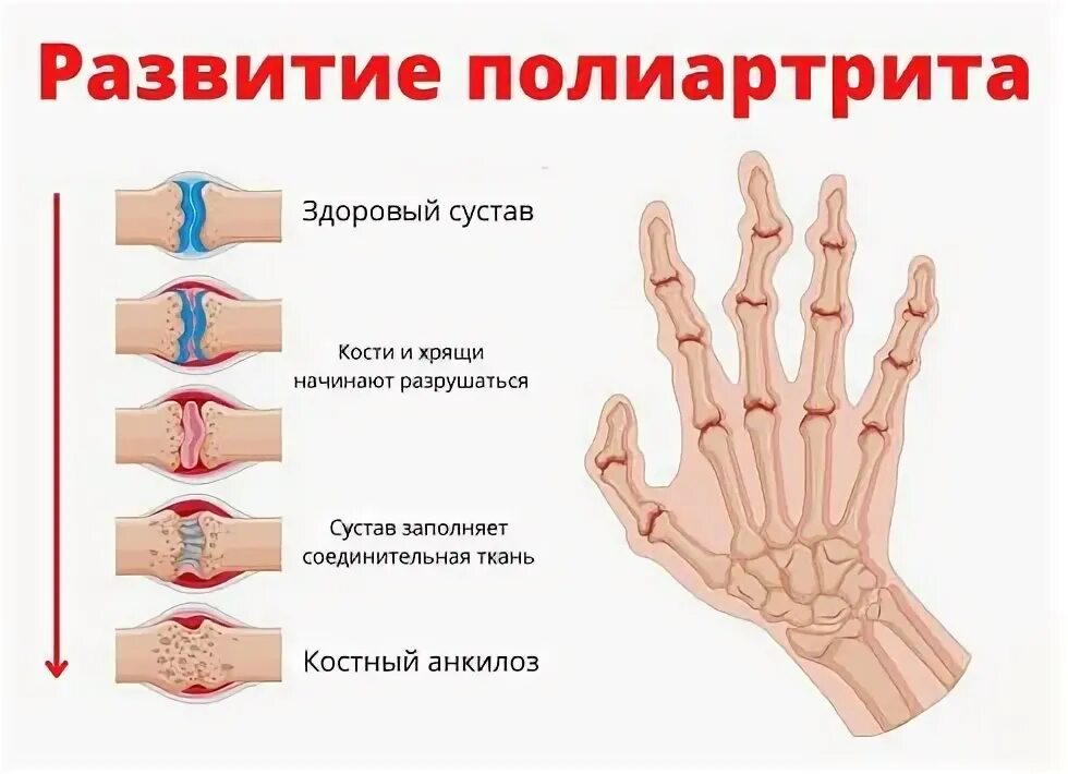 Полиартрит кистей рук симптомы лечение и фото Полиартрит - описание, цены, прием в Центре остеопатии