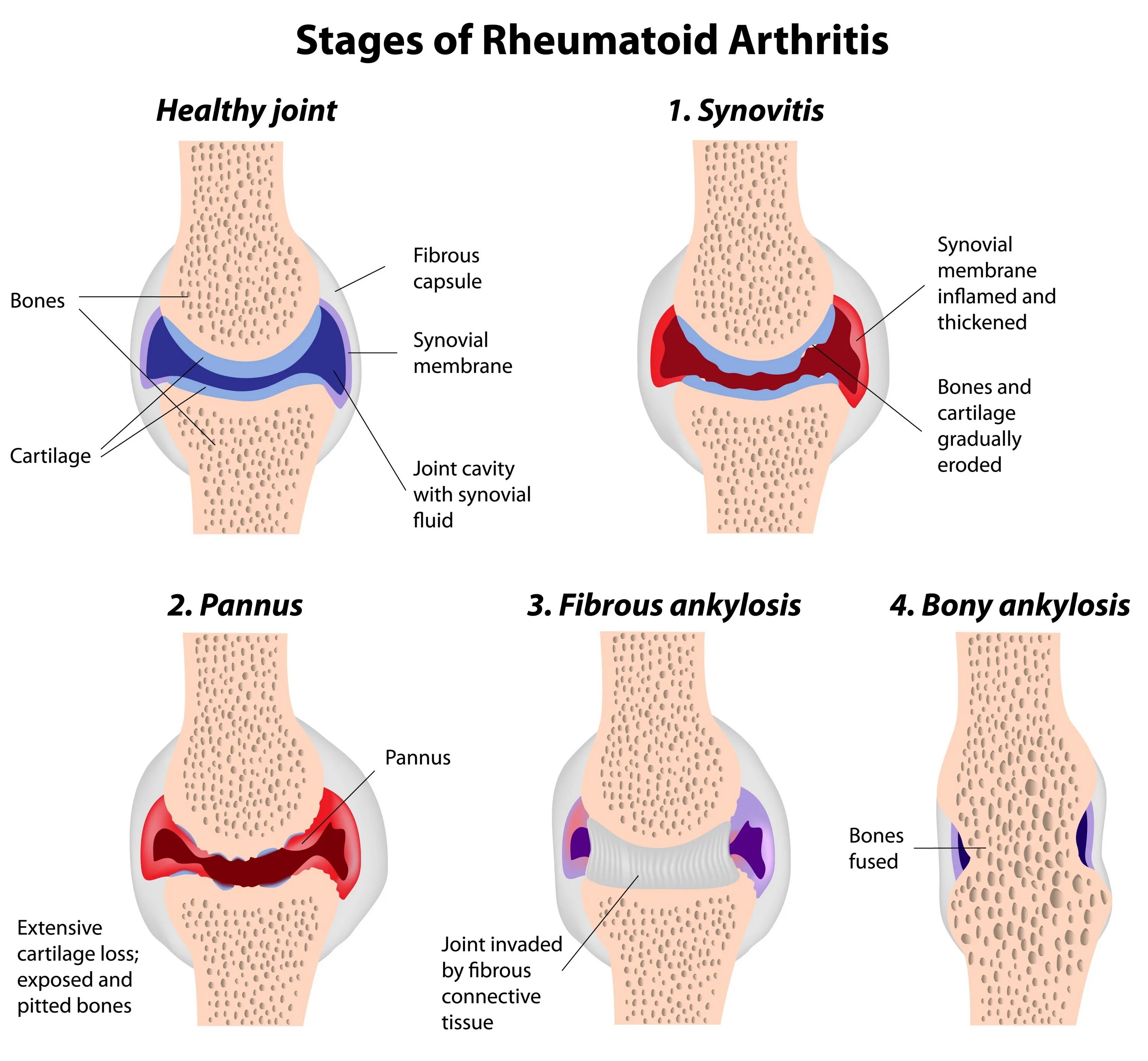 Полиартрит симптомы у мужчин и лечение фото Coastal Arthritis And Rheumatism Deals poligraf-ti.kz