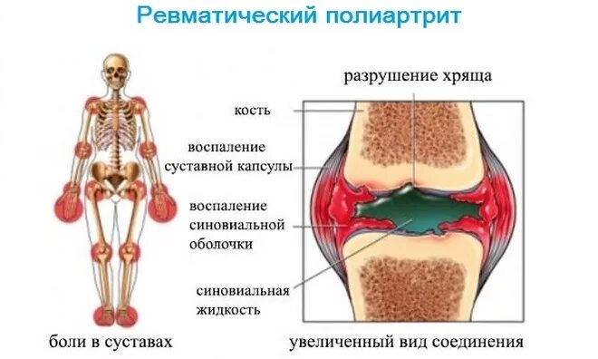 Полиартрит симптомы у мужчин и лечение фото Лечение ревматического артрита в Ивано-Франковске - медицинский центр Оксфорд Ме