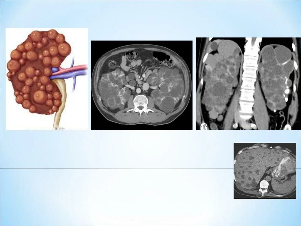 Поликистоз печени фото Презентация на тему: Сморщенная почка