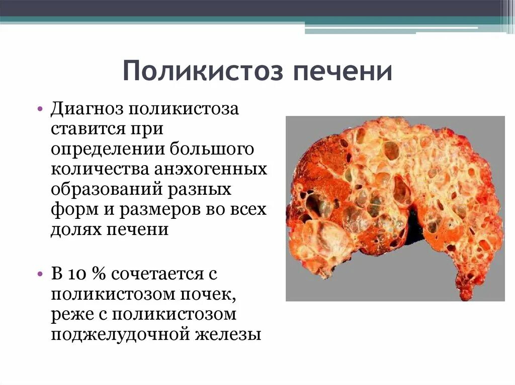 Поликистоз печени фото Ультразвуковая диагностика заболеваний печени - презентация онлайн