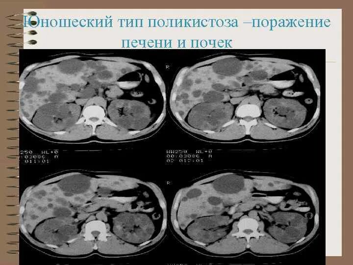 Поликистоз печени фото АНОМАЛИИ РАЗВИТИЯ ПОЧЕК Богданова Е О