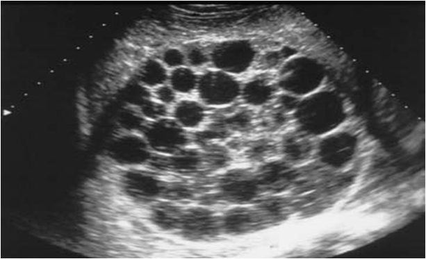 Поликистоз печени фото WK 2 LIVER PATHOLOGY Ultrasonography of Hydatid cyst of the liver Type III ( Gha