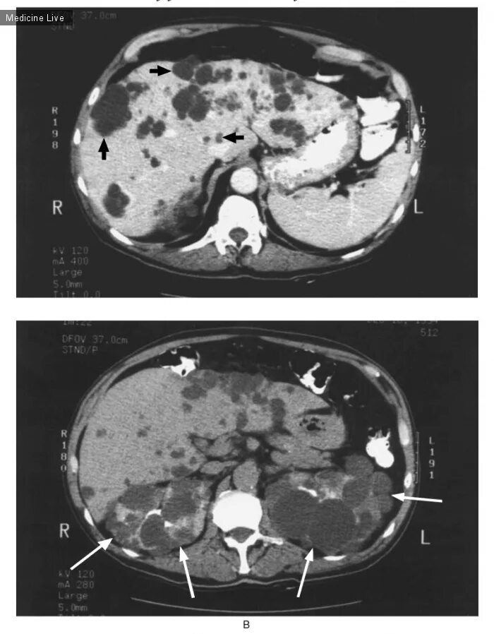 Поликистоз печени фото Поликистоз печени и почек / Интересный случай / Medicine Live