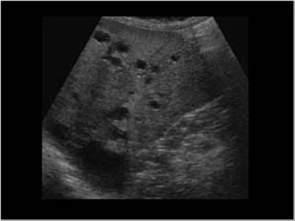 Поликистоз печени фото Abdomen and retroperitoneum 1.1 Liver : Case 1.1.4 Liver cysts Ultrasound Cases