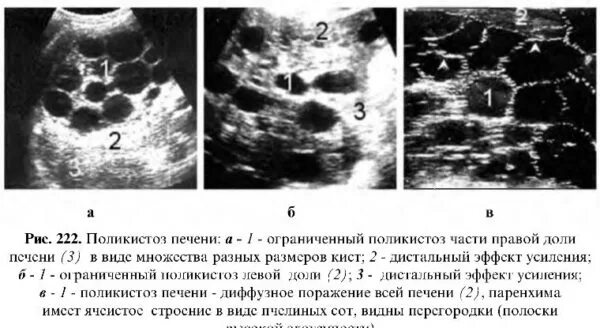 Поликистоз печени фото Поликистоз печени: причины и лечение, лекарства и диета