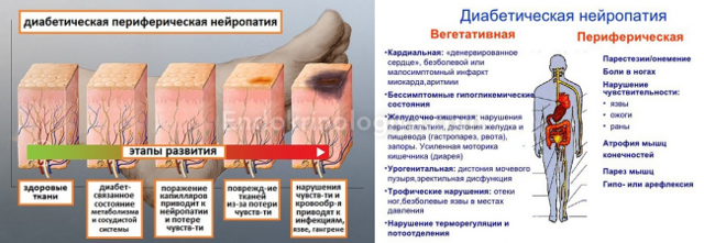 Полинейропатия нижних конечностей симптомы фото Причины нейропатии нижних конечностей у женщин