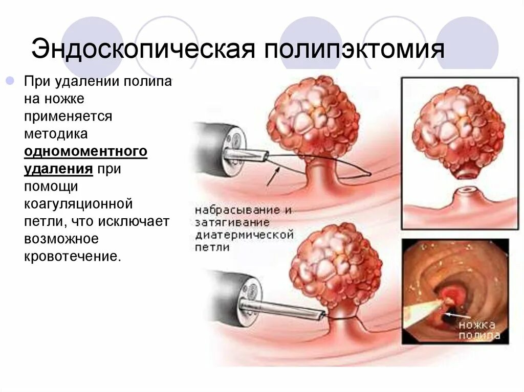 Полип как выглядит фото Удаление полипов матки реабилитация