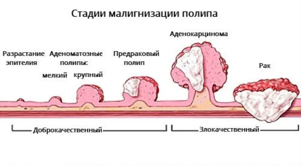 Полип как выглядит фото Рак кишечника - аденокарцинома толстой кишки: что это за опухоль, ее можно лечит