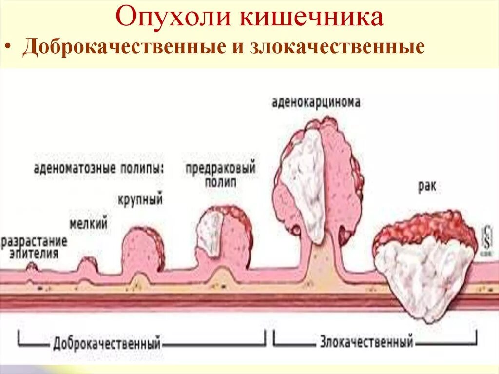 Полип как выглядит фото Рак тонкого кишечника: симптомы и проявление заболевания