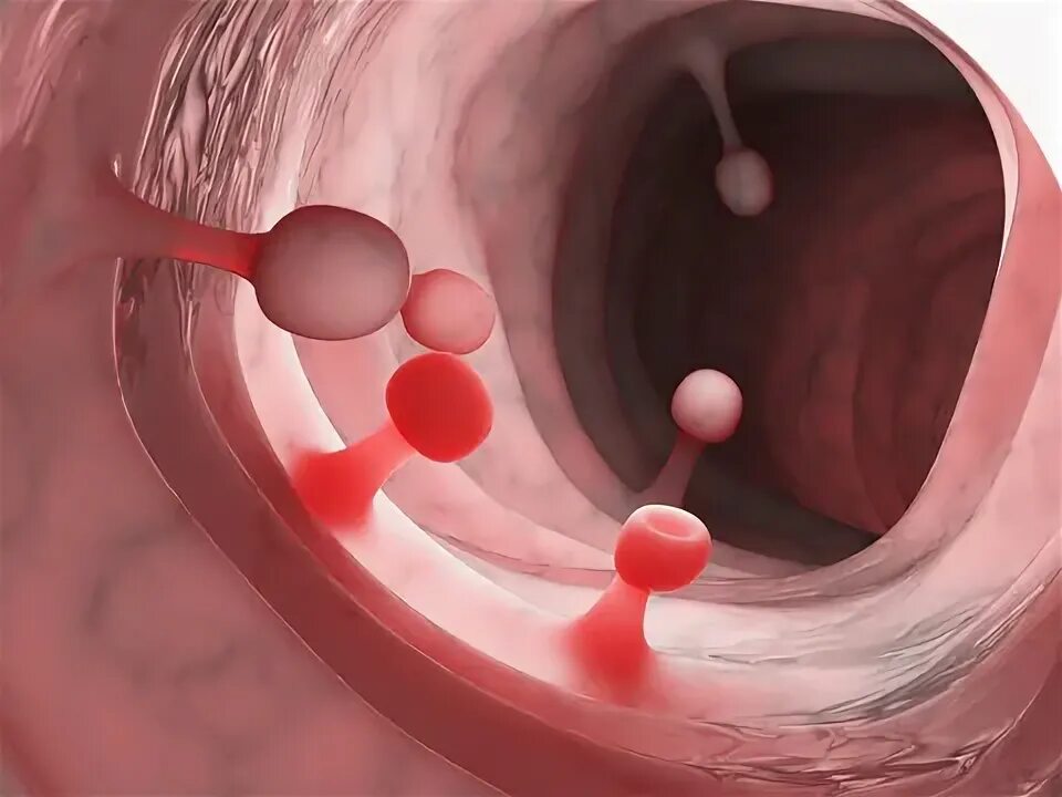 Полип как выглядит фото Colon Polyps Зображення - огляд 1,864 Стокові фото, векторні зображення й відео 