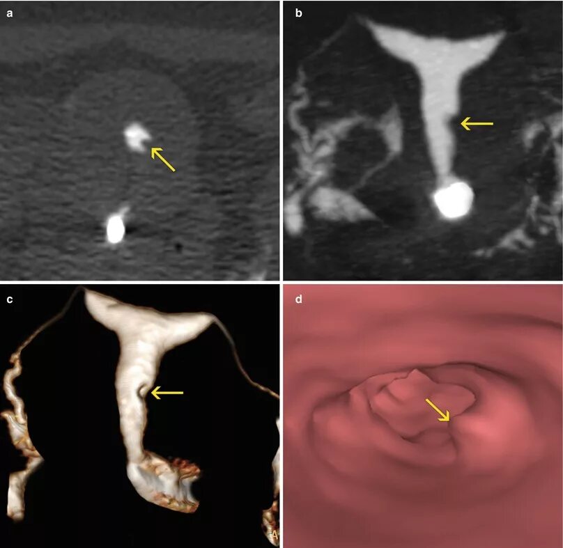 Полип как выглядит фото МПС. Radiology Key. Матка. Врожденные аномалии матки. Патология маточной стенки.