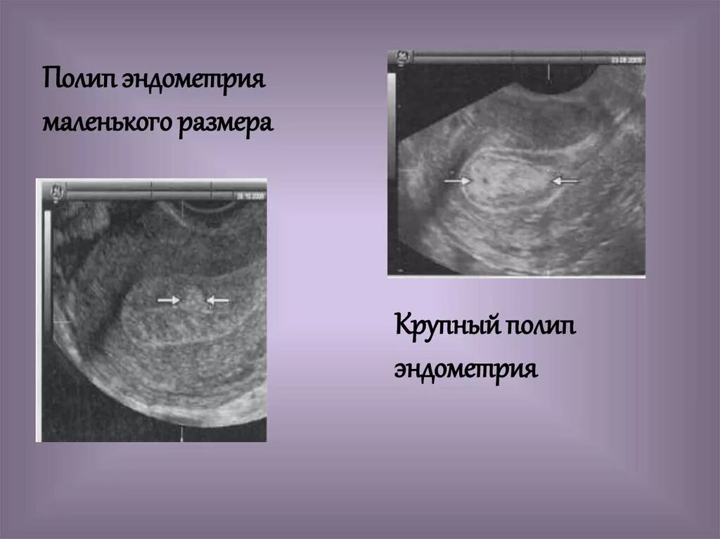 Полип как выглядит фото Остатки хориальной ткани