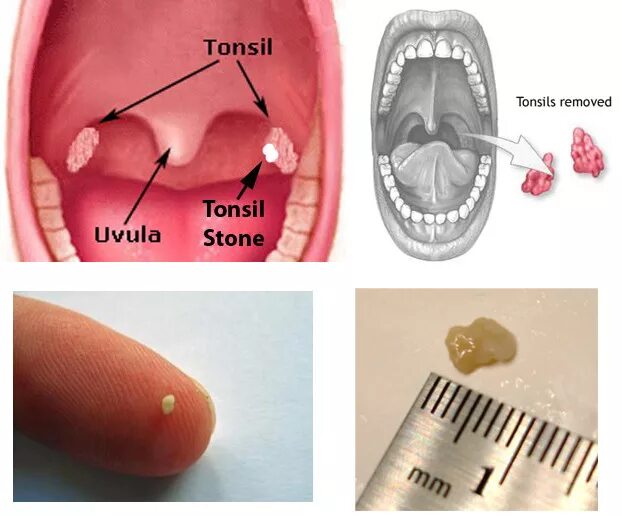 Полип на миндалине в горле фото Antibiotic for swollen tonsils