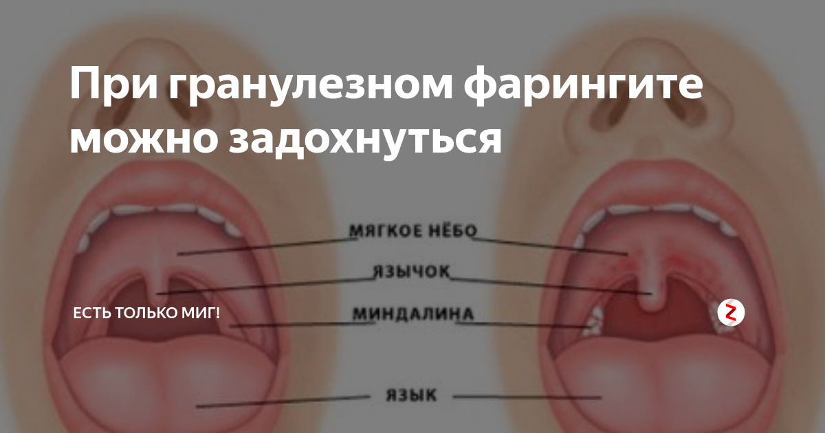 Полип на миндалине в горле фото Замер горла