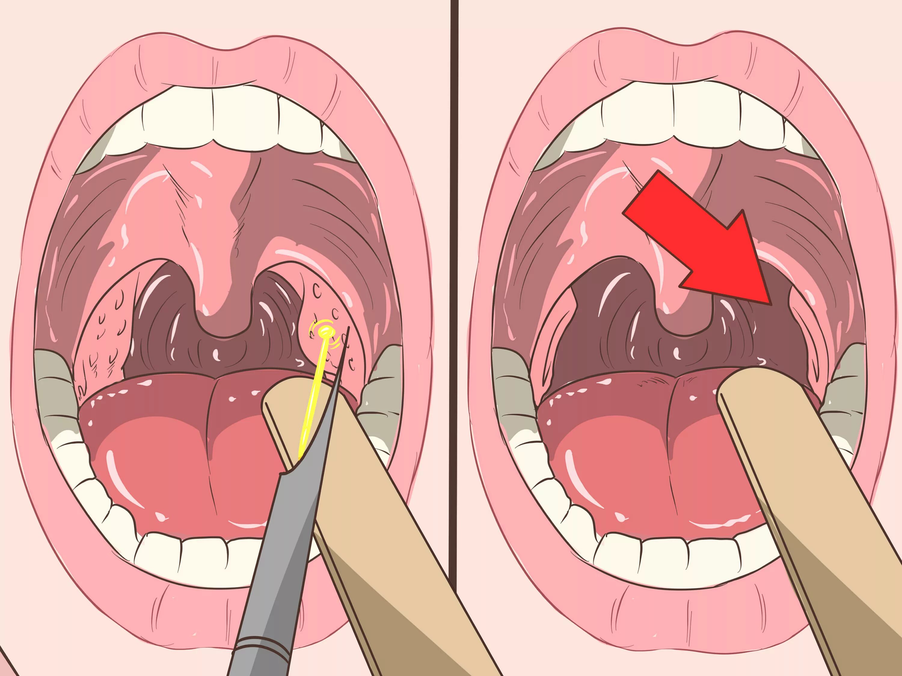 Полип на миндалине в горле фото 4 Ways to Remove Tonsil Stones (Tonsilloliths) - wikiHow